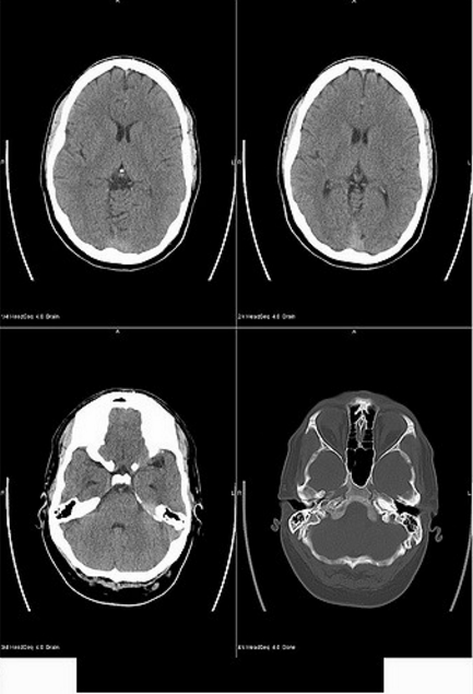 FL Officer in Training Fights for Compensability of Diagnostic Tests After Head Trauma
