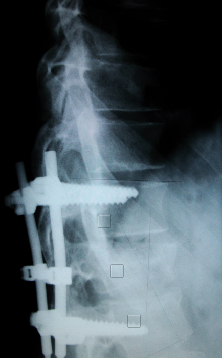 CWCI Releases Report on Characteristics of Spinal Fusion Claims in CA